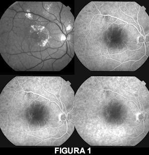 retinografia a luce aneritra (in alto a sinistra) e fluoroangiografia 
     (in alto a destra e in basso)