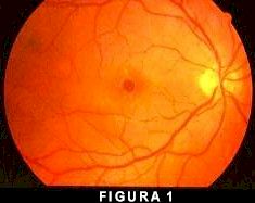 fluorangiografia