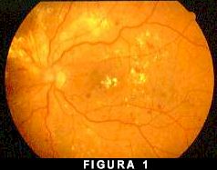 Retinopatia diabetica non proliferante