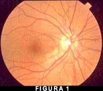 Fig. 1 - strie angioidi