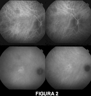 angiografia con il verde di indocianina