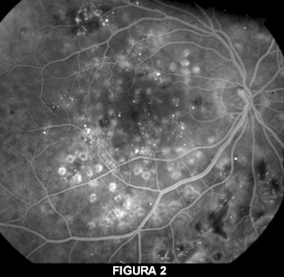 edema maculare diabetico