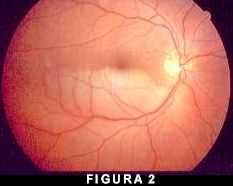 occlusione di branca dell'arteria centrale della retina