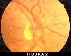 Retinopatia diabetica proliferante