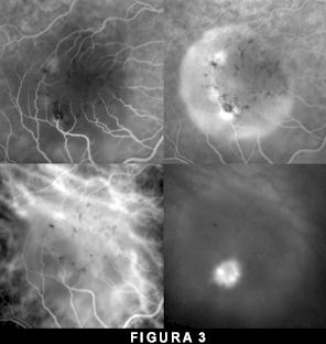 OCT per quantificare i danni all'interno della retina