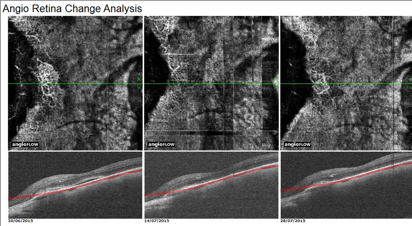 Angio OCT - Nuova tecnica di imaging senza contrasto