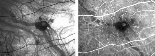 Fig 3 - macular hemorrhage