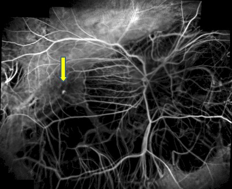 Fig.5 - Myopic CNV is usually very small