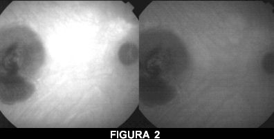 angiografia con il verde di indocianina